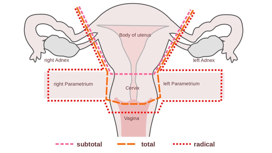 Abdominal Hysterectomy