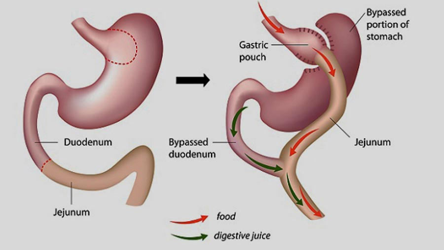 Best Bariatric Surgery in Surat