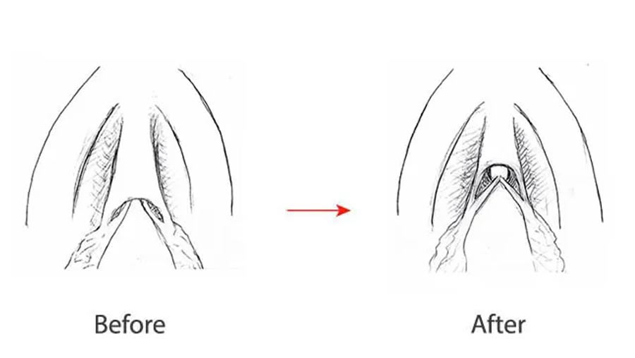 Clitoral Hood Reduction