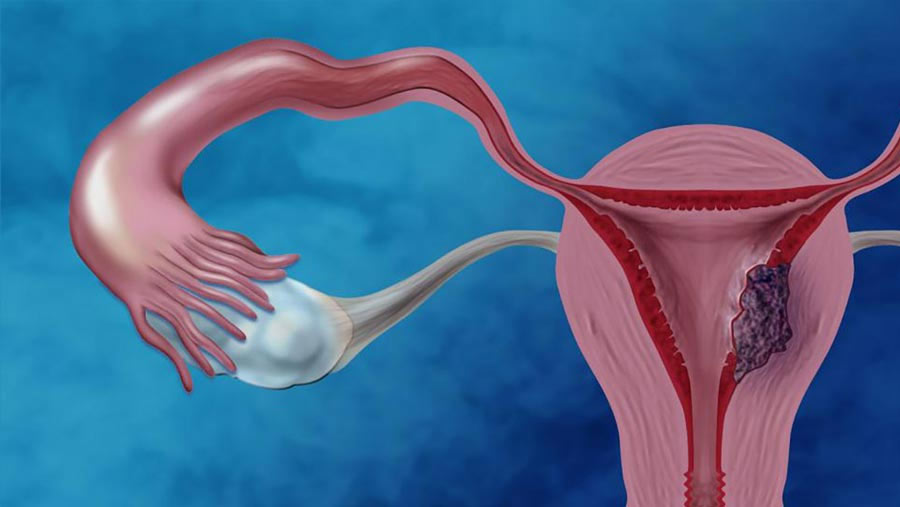 Endometrial Cancer - Candorivf.com