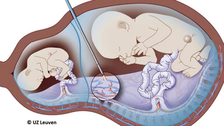 Best Fetal Therapy in Surat - Candorivf.com