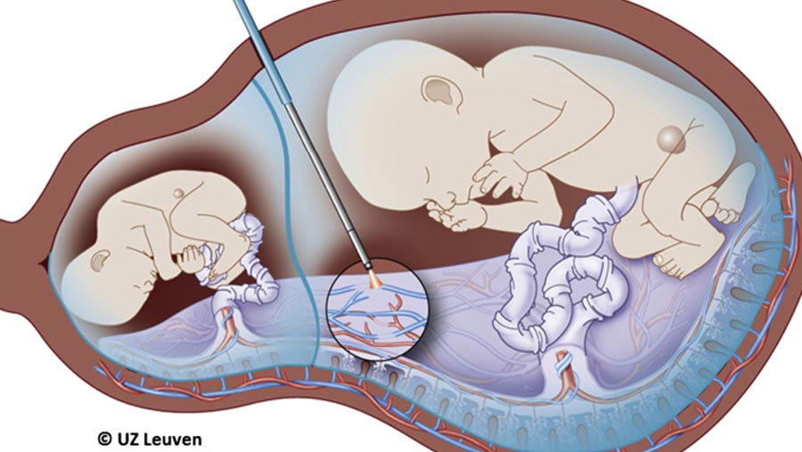 Fetal Therapy