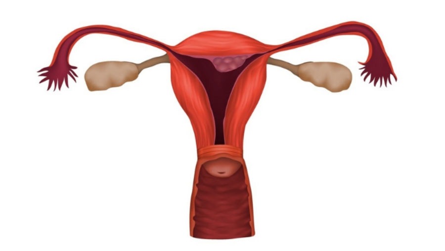 Fibroid Removal