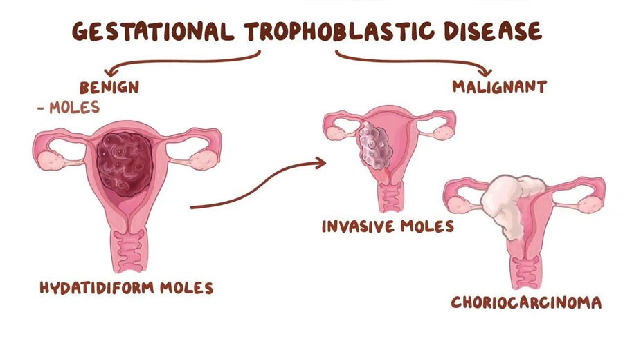 Gestational Trophoblastic Disease