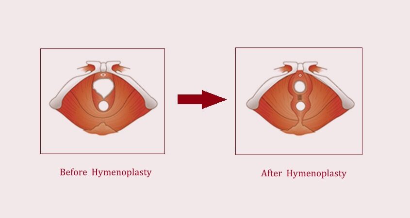 Hymenoplasty