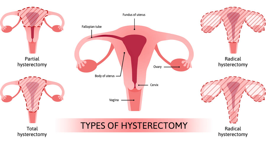 Hysterectomy - Candorivf.com
