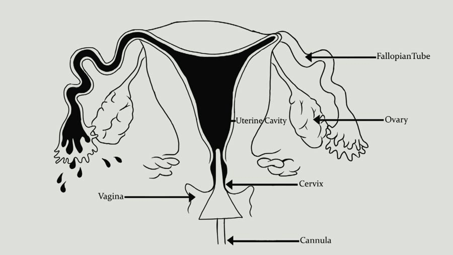 Hysterosalpingography