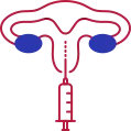Embryo Transfer - Candrivf.com