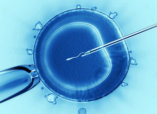 Intracytoplasmic Sperm Injection