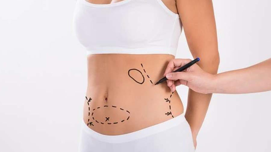 Bt Liposuction Surgery in Surat