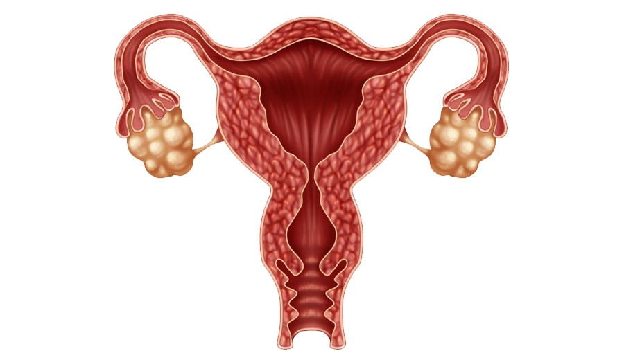 Oophorectomy