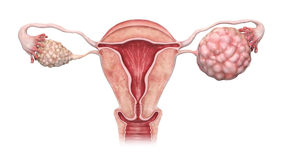 Ovarian Cancer Treatment