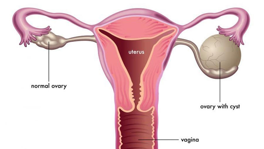 Ovary Treatment - Candorivf.com