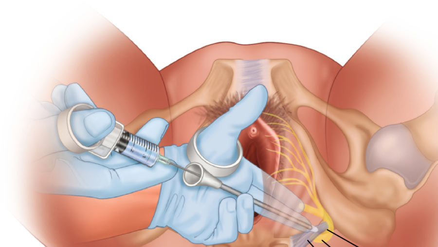 Perineoplasty Surgery in Surat - Candorivf.cm