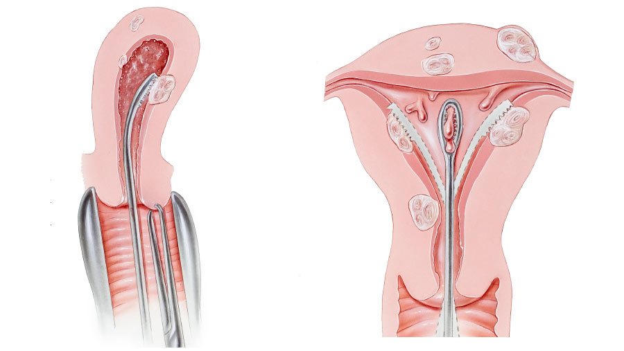 Septal Resection