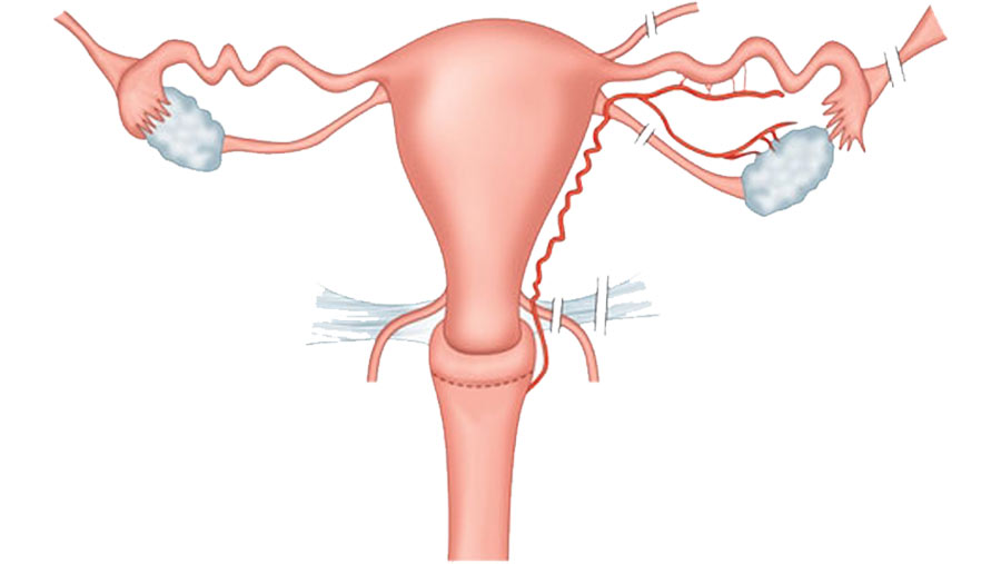 Total Laparoscopic Hysterectomy - Candorivf.com