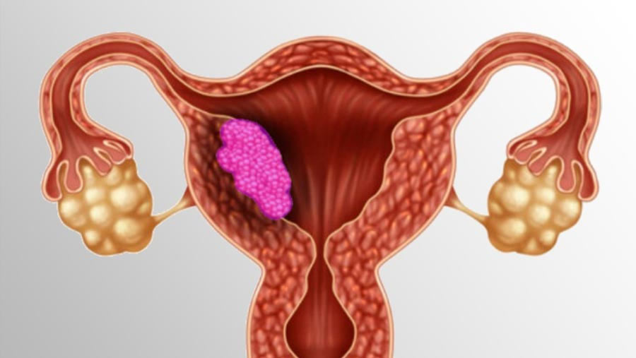 Uterine Sarcoma Treatment