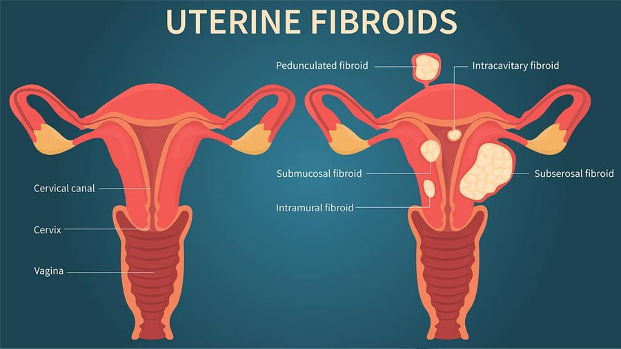 Uterus Treatment - Candorivf.com