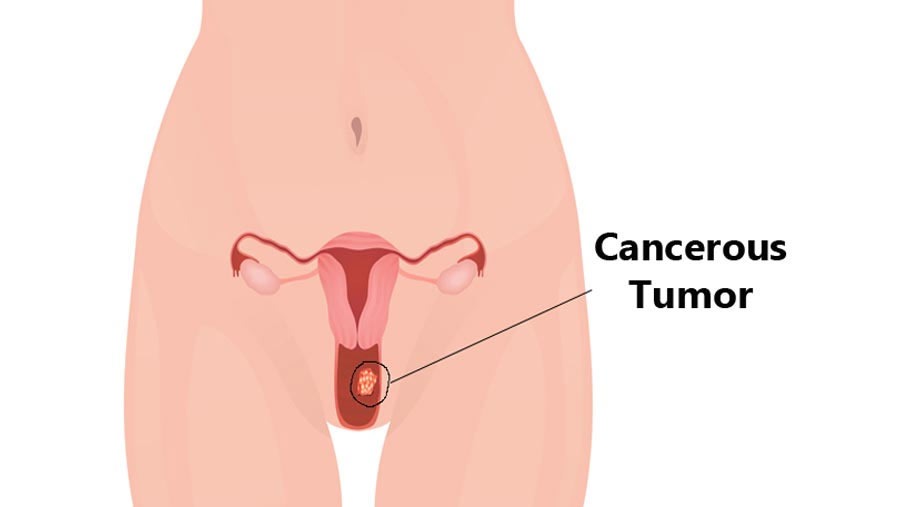 Vaginal Cancer Treatment - Candorivf.com