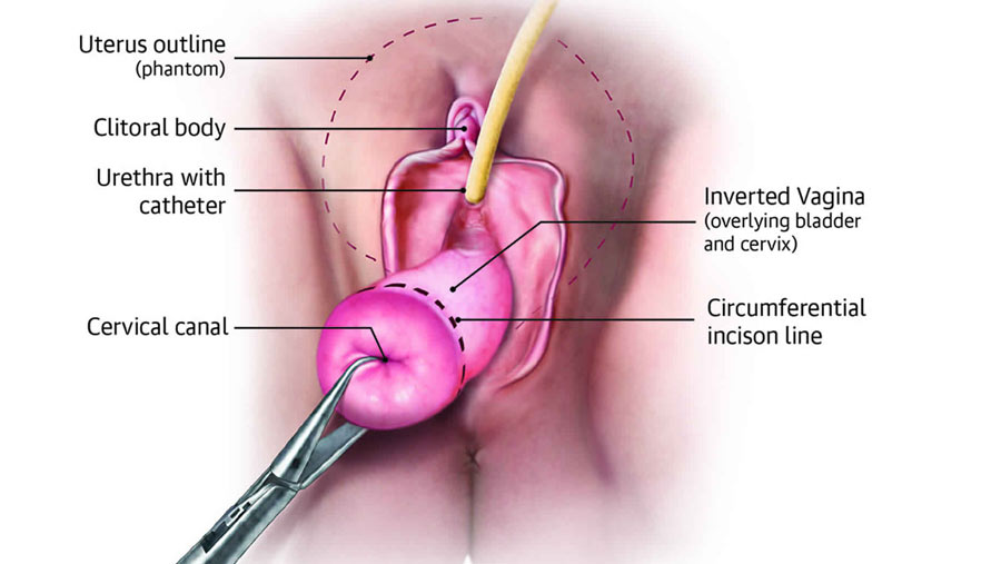 Vaginal Hysterectomy - Candorivf.com