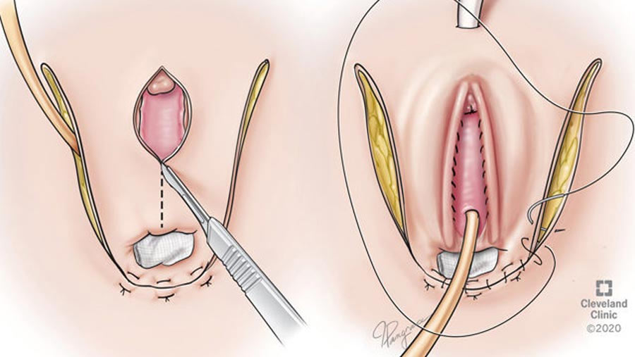 Vaginoplasty Surgery in Surat