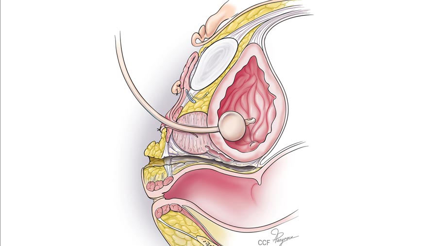 Vulvoplasty Surgery in Surat