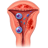 Chronic endometritis