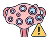 Risk of Ovarian Hyperstimulation Syndrome (OHSS).